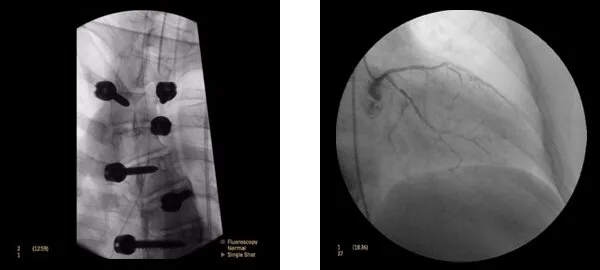 Клинические изображения Philips Veradius Unity С-дуга