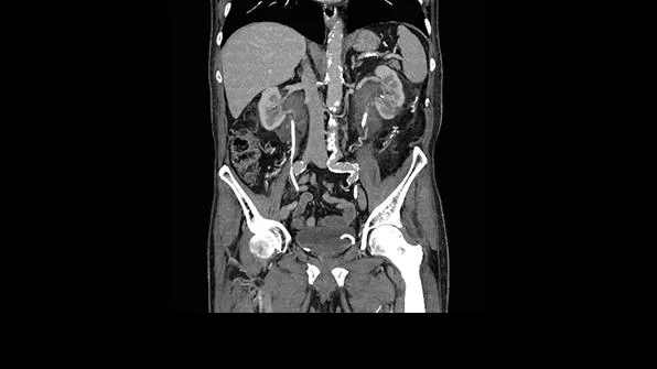 Клинические изображения Siemens SOMATOM go.Now компьютерный томограф