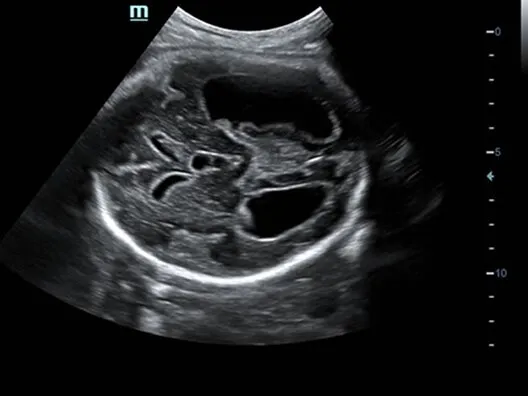 Клинические изображения УЗИ аппарат Mindray DC-70 Exp