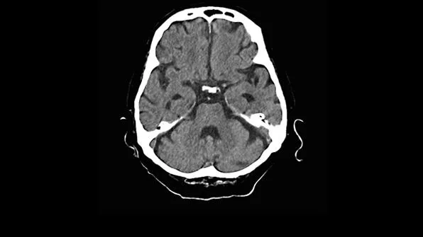 Клинические изображения Siemens SOMATOM go.Now компьютерный томограф