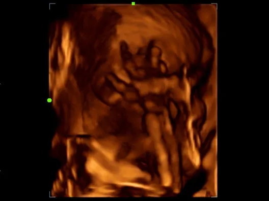 Клинические изображения УЗИ аппарат Mindray Z60 портативный