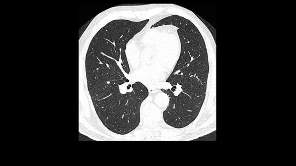 Клинические изображения Siemens SOMATOM go.Now компьютерный томограф