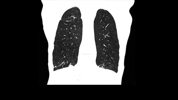 Клинические изображения Siemens SOMATOM go.Now компьютерный томограф