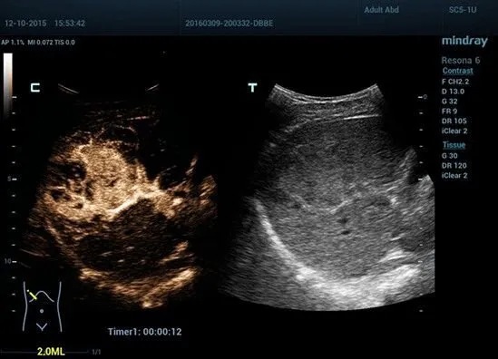 Клинические изображения УЗИ аппарат Mindray Resona 6 Exp