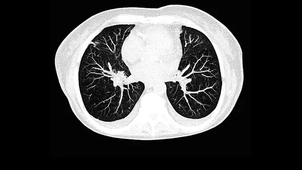 Клинические изображения Siemens SOMATOM go.Now компьютерный томограф