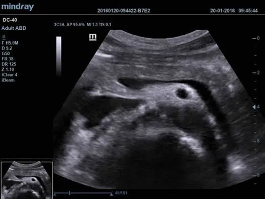 Клинические изображения УЗИ аппарат Mindray DC-40 Exp