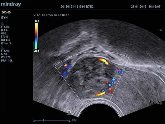 Клинические изображения УЗИ аппарат Mindray DC-40