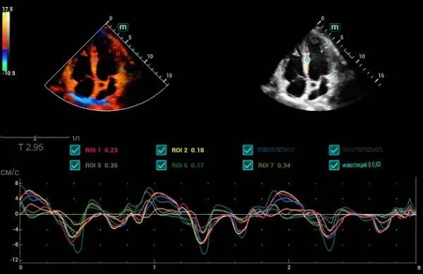 Клинические изображения УЗИ аппарат Mindray Consona N8
