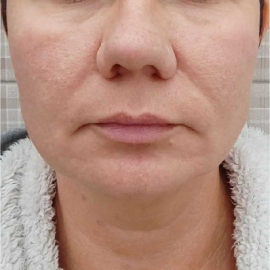 NeoGen омоложение анфас после.jpg NeoGen омоложение анфас после.jpg