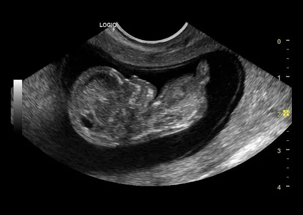 Клинические изображения GE Logiq F8 аппарат УЗИ