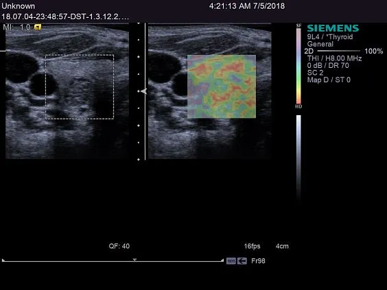 Клинические изображения Siemens ACUSON S2000 ультразвуковая система