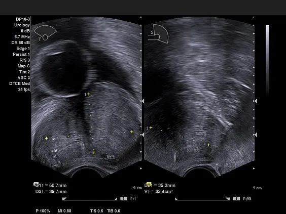 Клинические изображения Ультразвуковая система Siemens Acuson NX3