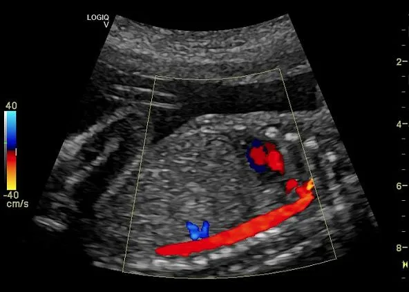 Клинические изображения Ультразвуковая диагностическая система GE Logiq V5