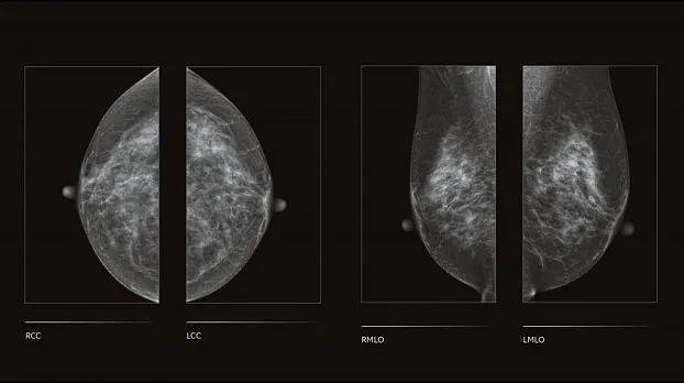 Клинические изображения Цифровой маммограф GE Senographe Crystal Nova