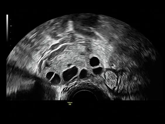 Клинические изображения GE Voluson S6 аппарат УЗИ