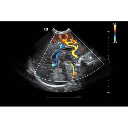 Клинические изображения УЗИ аппарат Mindray DC-70S