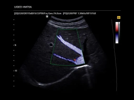 Клинические изображения Samsung Medison HM70 EVO УЗИ аппарат портативный