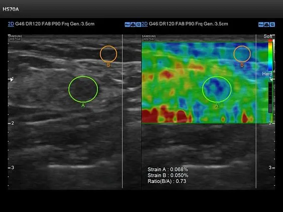 Клинические изображения Samsung Medison HS70A УЗИ аппарат