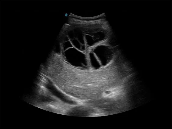 Клинические изображения Sonoscape X3 ультразвуковой аппарат