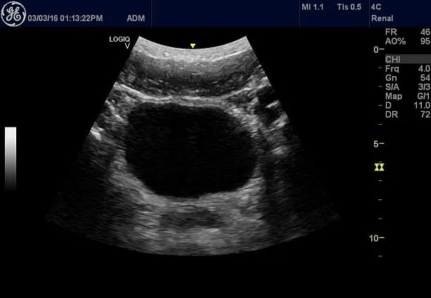 Клинические изображения Ультразвуковая диагностическая система GE Logiq V2 УЗИ портативная