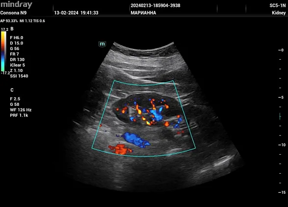 Клинические изображения УЗИ аппарат Mindray Consona N9
