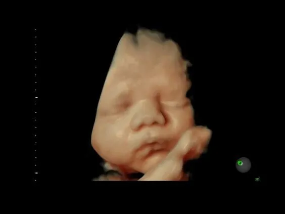 Клинические изображения УЗИ аппарат GE HealthCare Voluson E8 