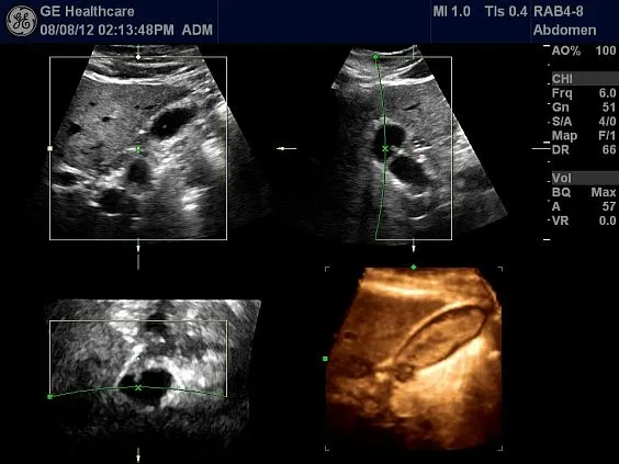 Клинические изображения Ультразвуковая диагностическая система GE Logiq S7 XDclear