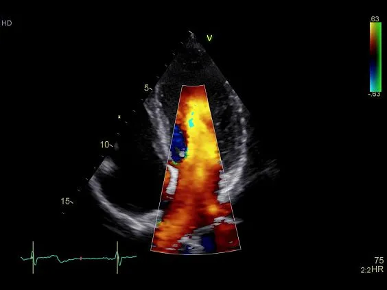 Клинические изображения GE Vivid S70 УЗИ аппарат