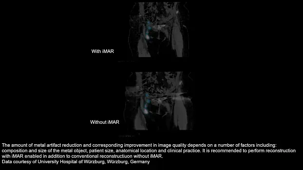 Клинические изображения Siemens Symbia Intevo Bold КТ аппарат 