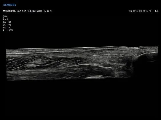 Клинические изображения Samsung Medison V7 УЗИ аппарат