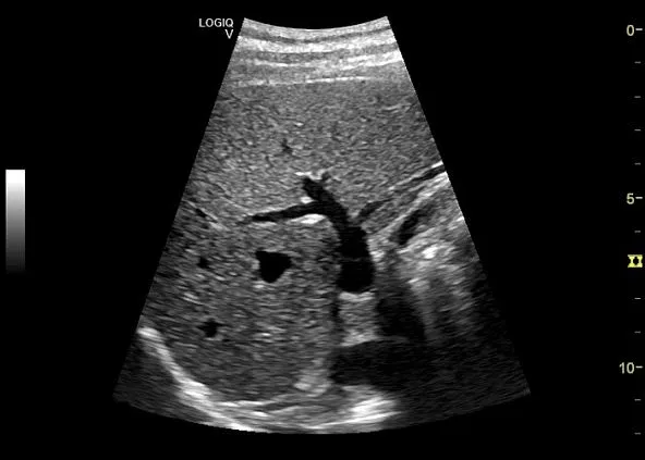 Клинические изображения Ультразвуковая диагностическая система GE Logiq V5