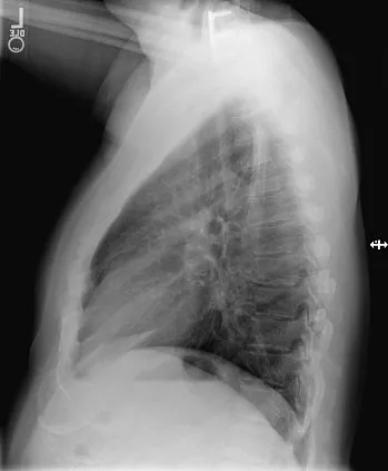 Клинические изображения Цифровой рентгеноcкопический аппарат Siemens Luminos Agile Max