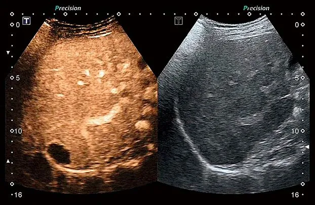 Клинические изображения Canon (Toshiba) Aplio 300 УЗИ аппарат