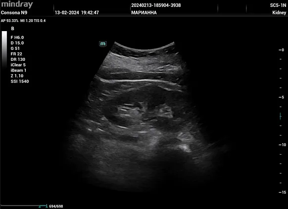 Клинические изображения УЗИ аппарат Mindray Consona N9