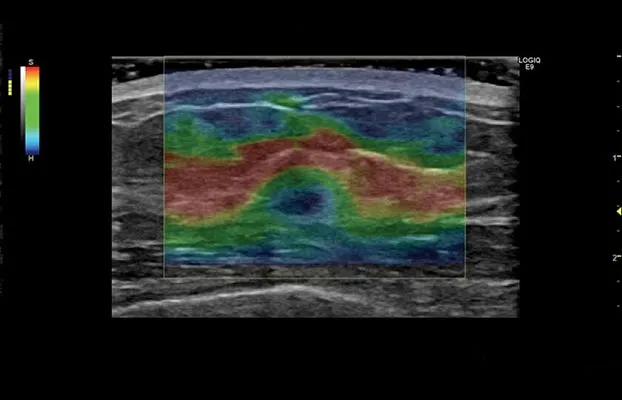 Клинические изображения УЗИ аппарат GE Healthcare Logiq E9 XDclear