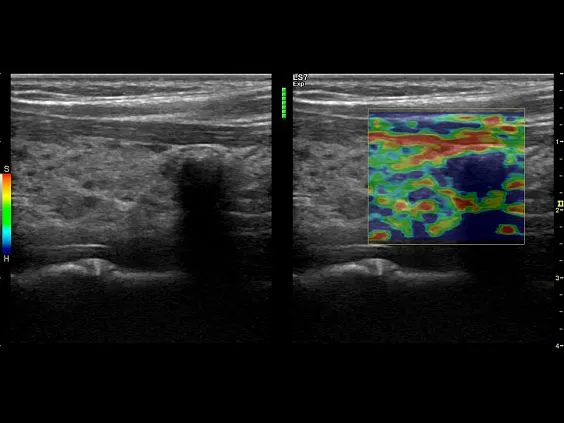 Клинические изображения Ультразвуковая диагностическая система GE Logiq S7 XDclear