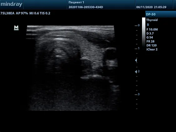 Клинические изображения УЗИ аппарат Mindray DP-50 Color портативный