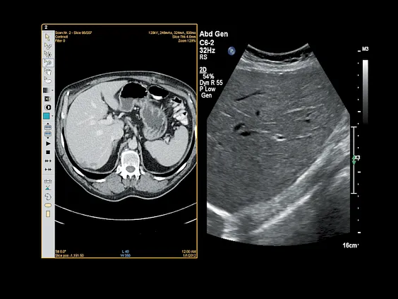 Клинические изображения Philips Affiniti 70 ультразвуковой аппарат