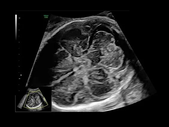 Клинические изображения Ультразвуковая диагностическая система GE Voluson E10