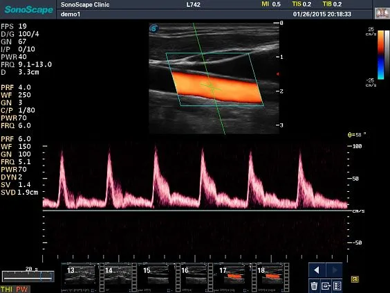 Клинические изображения Sonoscape S8 Exp ультразвуковой аппарат