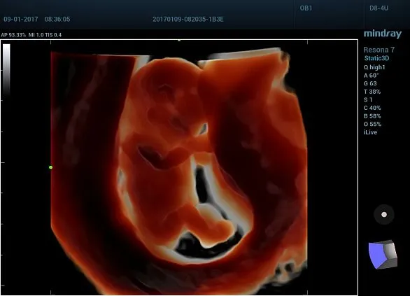 Клинические изображения УЗИ аппарат Mindray Resona 7