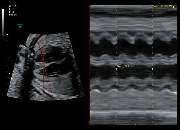 Клинические изображения Ультразвуковая диагностическая система GE HealthCare Voluson E6