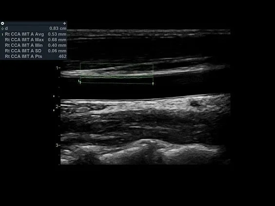 Клинические изображения Ультразвуковая диагностическая система GE Vivid S60