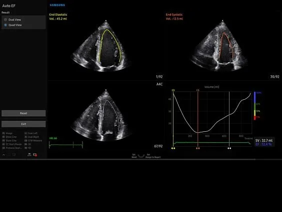 Клинические изображения Samsung Medison V8 УЗИ аппарат
