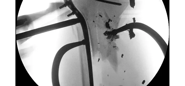 Клинические изображения Philips BV Pulsera С-дуга