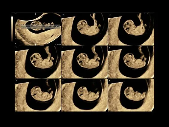 Клинические изображения УЗИ аппарат GE HealthCare Voluson E8 