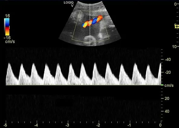 Клинические изображения Ультразвуковая диагностическая система GE Logiq V5