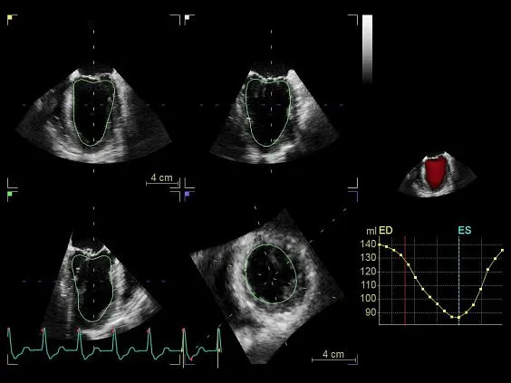 Клинические изображения GE Vivid S70 УЗИ аппарат