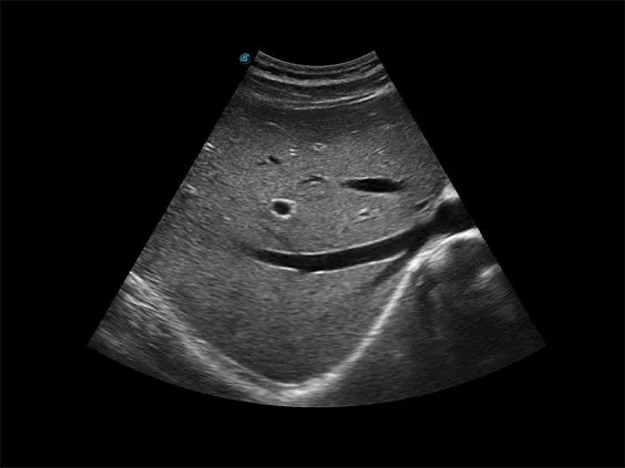 Клинические изображения Sonoscape X3 ультразвуковой аппарат