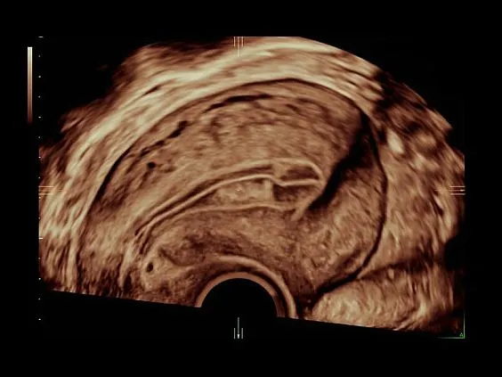 Клинические изображения Ультразвуковая диагностическая система GE Voluson E10